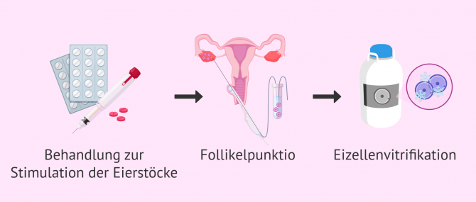 Imagen: Eizellenvitrifikation