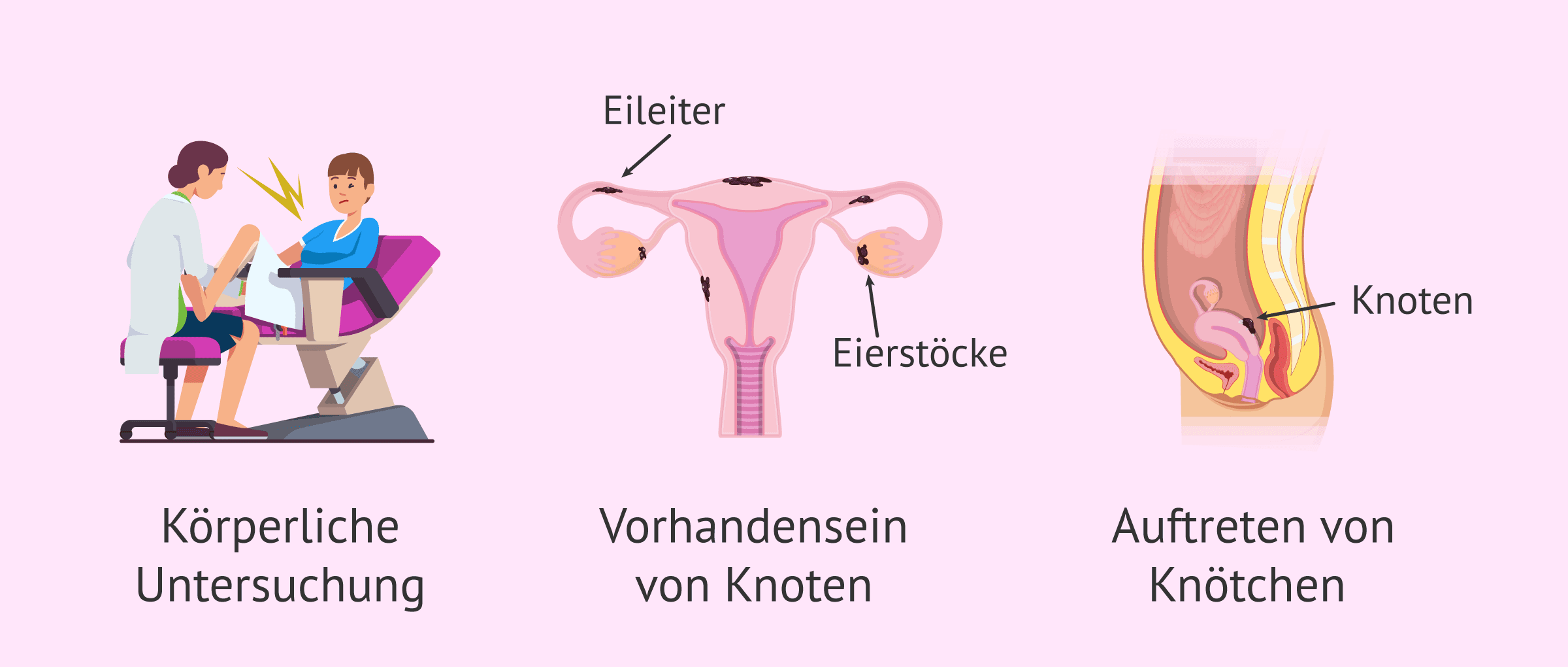 Imagen: Was kann auf eine Endometriose hindeuten?