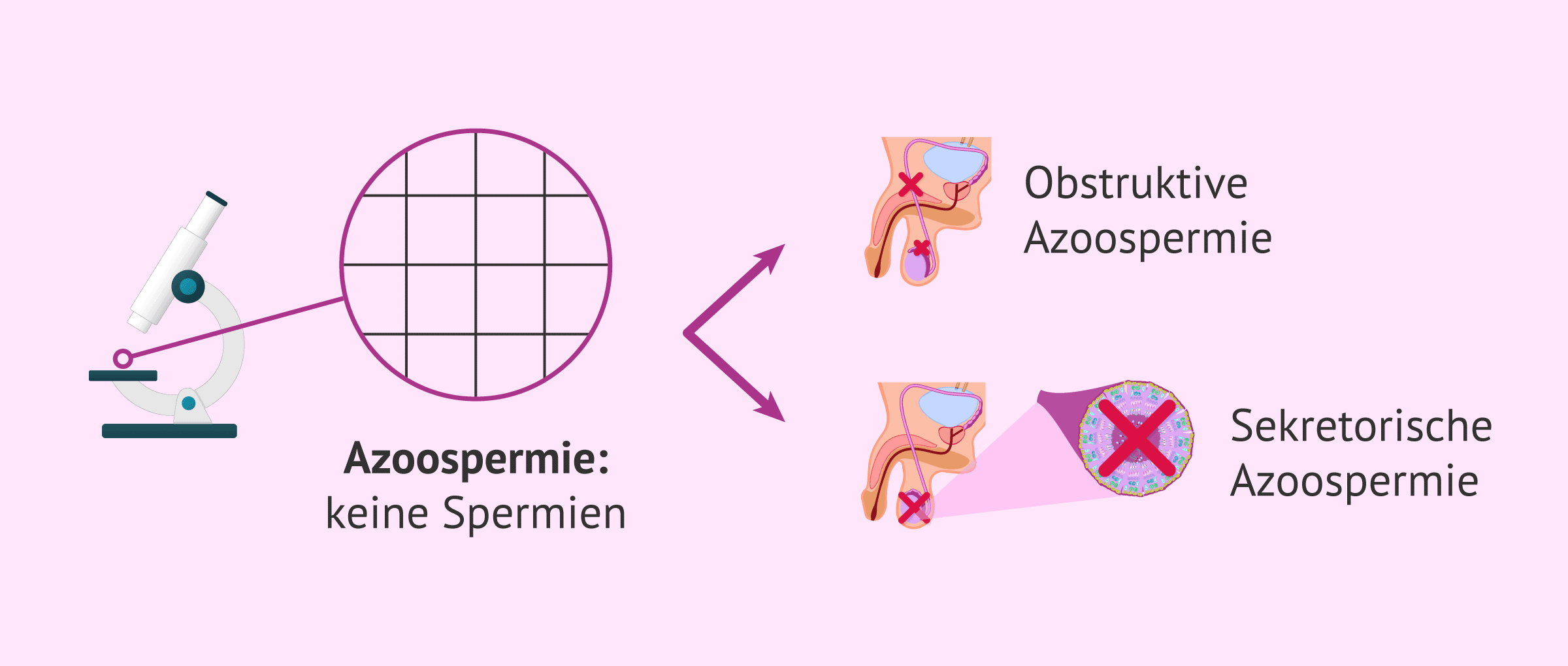 Imagen: Welche Arten von Azoospermie gibt es?