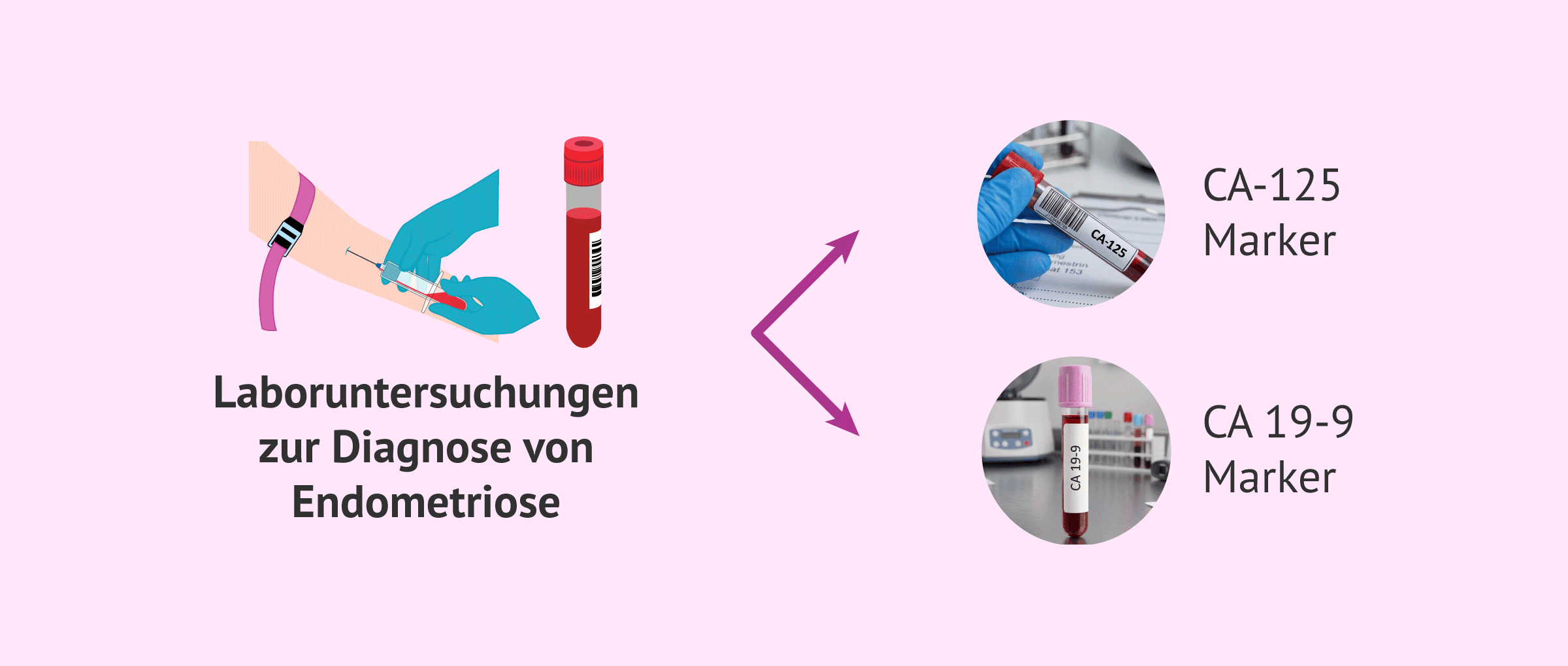 Imagen: Analyse von Tumormarkern bei der Diagnose von Endometriose