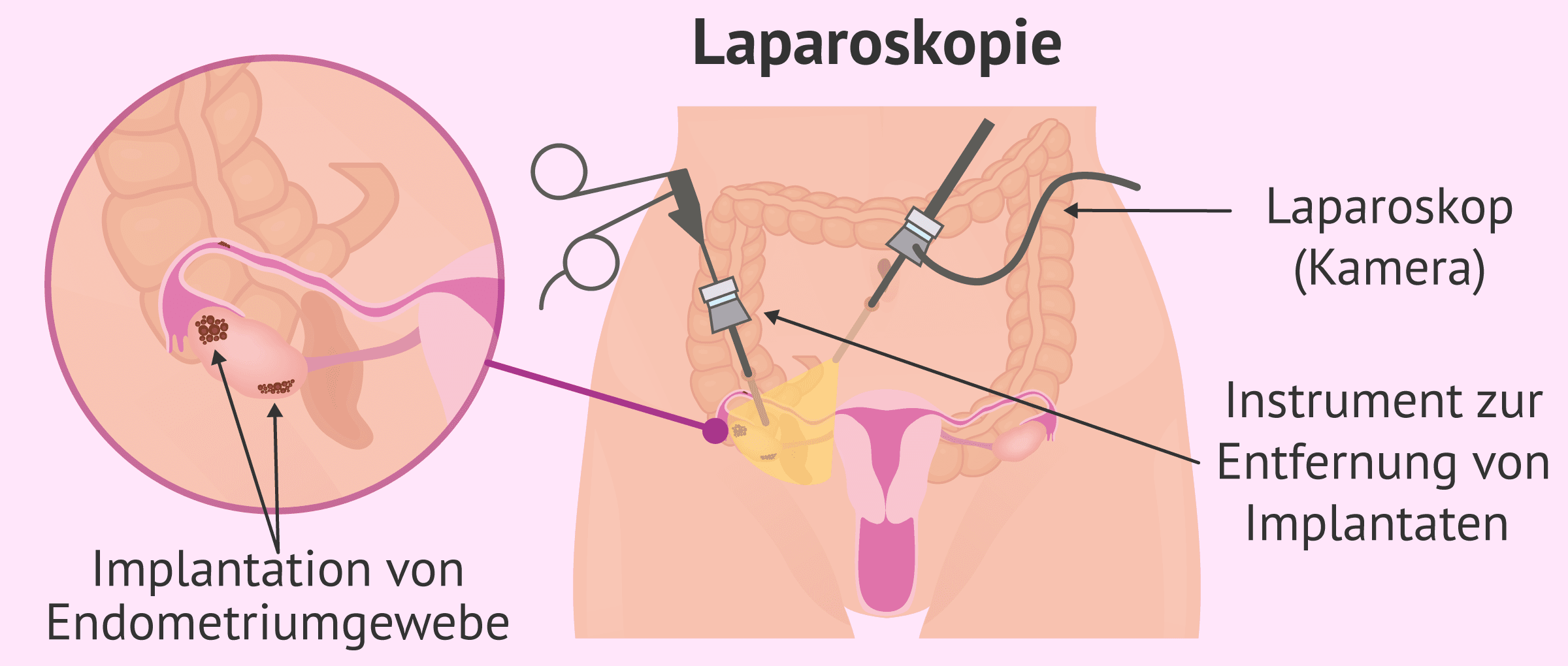 Imagen: Laparoskopie zur Diagnose von Endometriose
