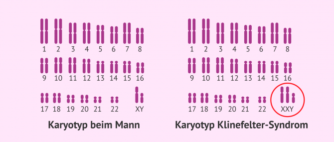 Imagen: Normaler Karyotyp und Karyotyp bei Klinefelter-Syndrom