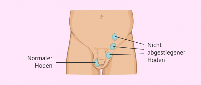 Imagen: Was ist Kryptorchismus?