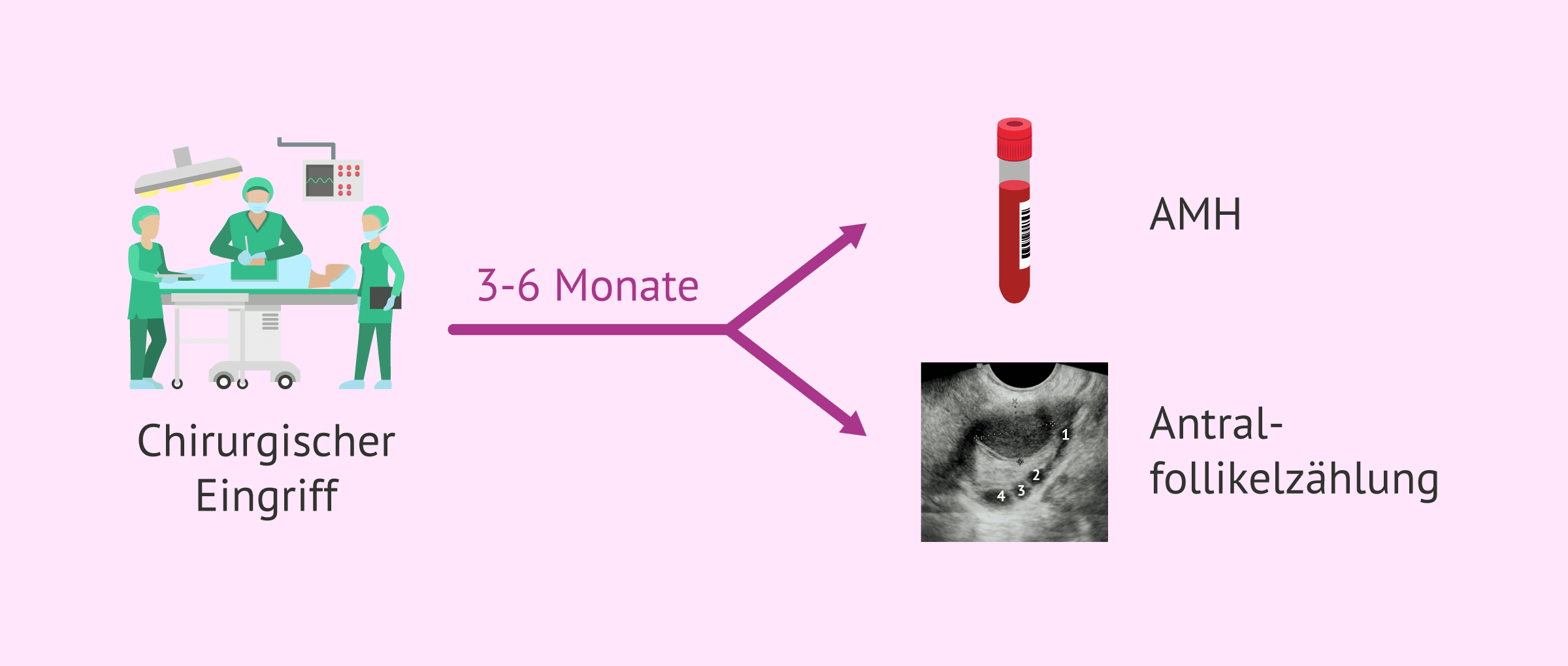 Imagen: Ovarialreserve nach Endometriose-Operation
