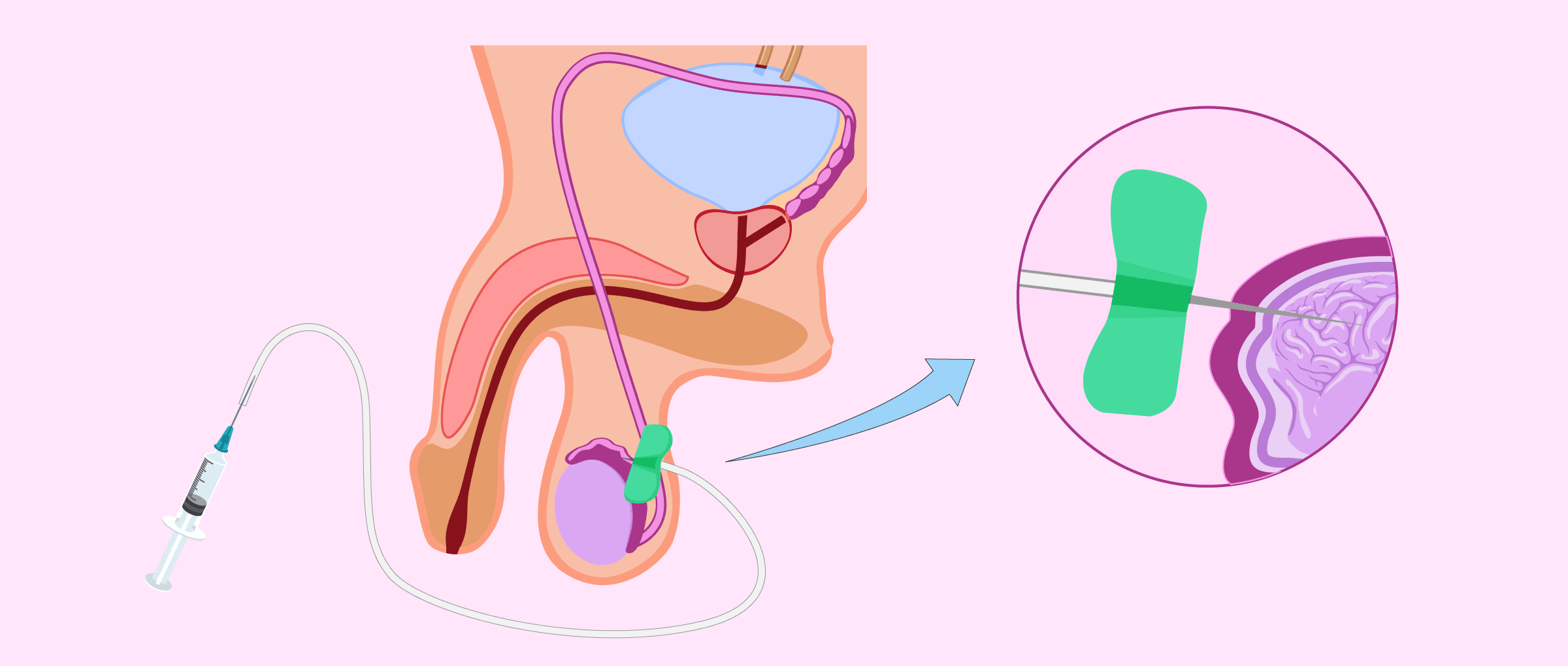 Imagen: Perkutane epididymale Spermienaspiration (PESA)