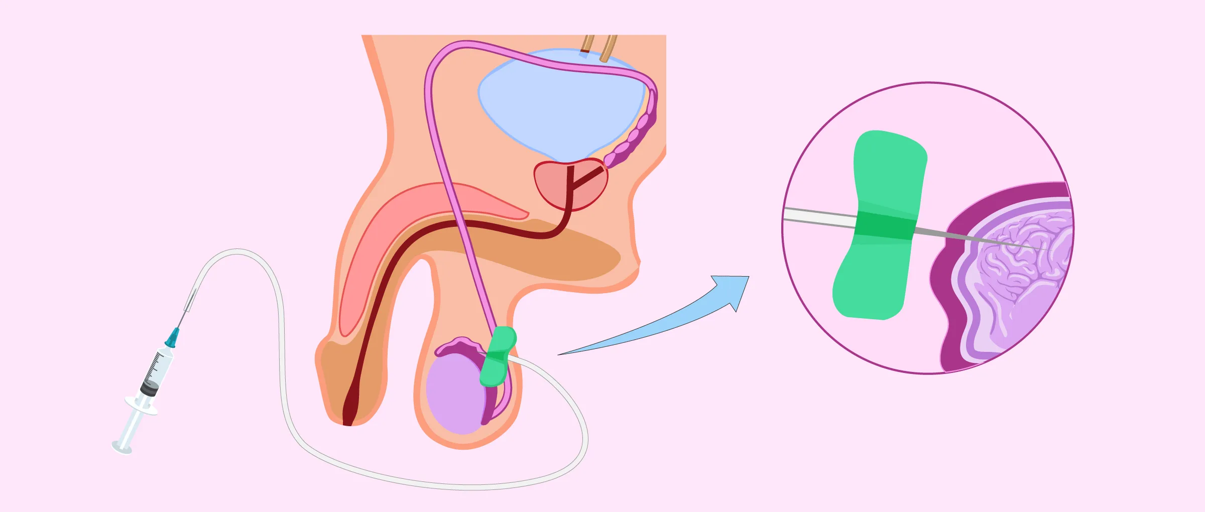 Imagen: Perkutane epididymale Spermienaspiration (PESA)