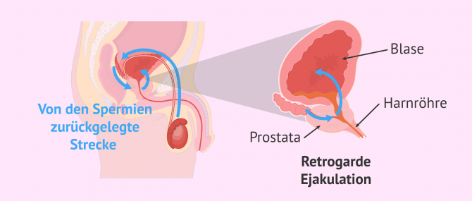 Imagen: Prozess bei retrogarder Ejakulation