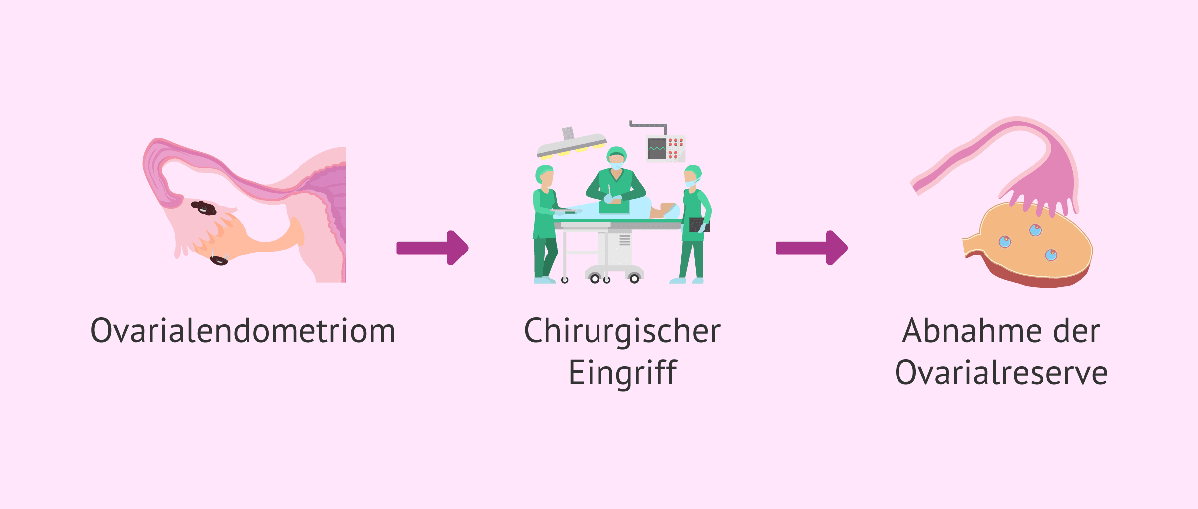 Endometriom-Operation: Techniken zur Schonung der Ovarialreserve