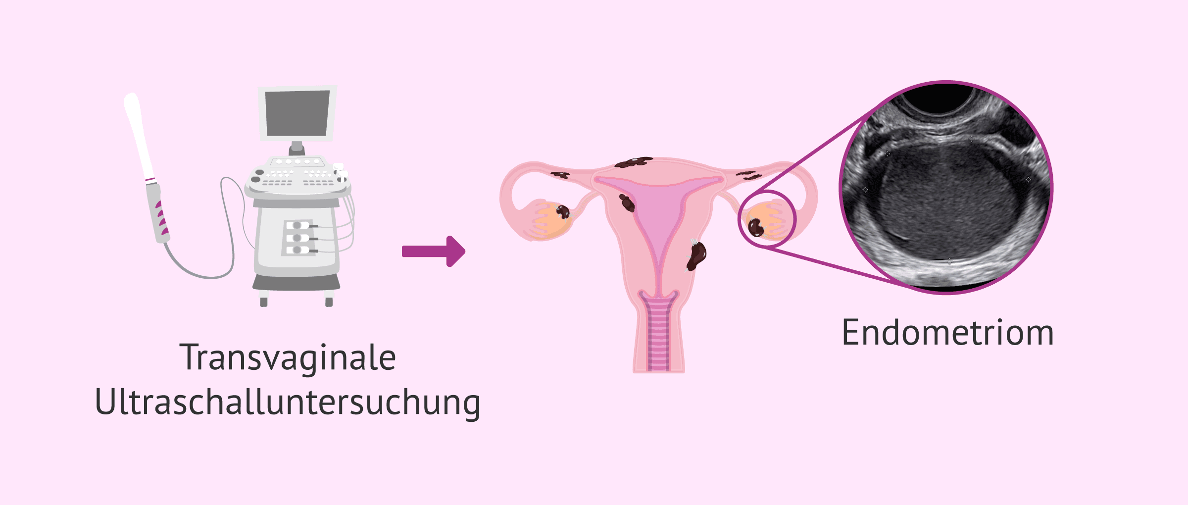 Diagnose der Endometriose: Bluttests und bildgebende Verfahren