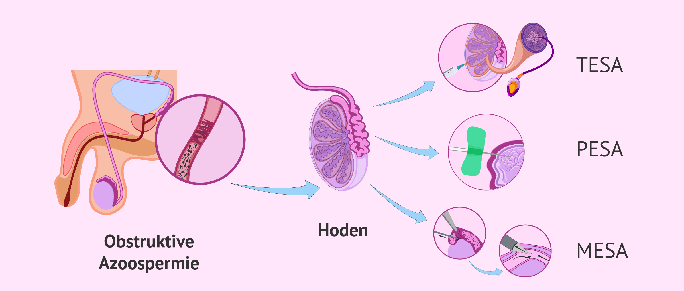 Imagen: Was sind die Methoden zur Spermienaspiration?