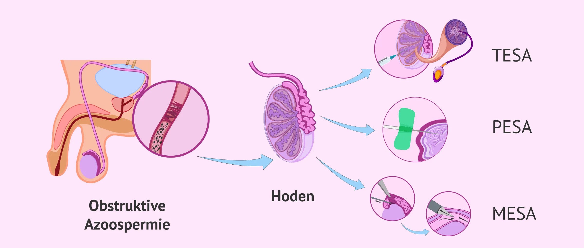 Imagen: Was sind die Methoden zur Spermienaspiration?