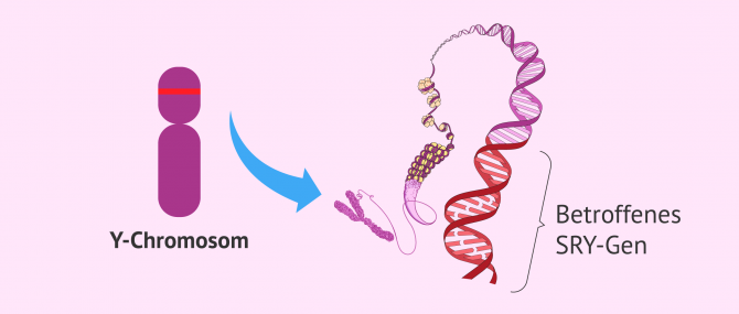 Imagen: Swyer-Syndrom