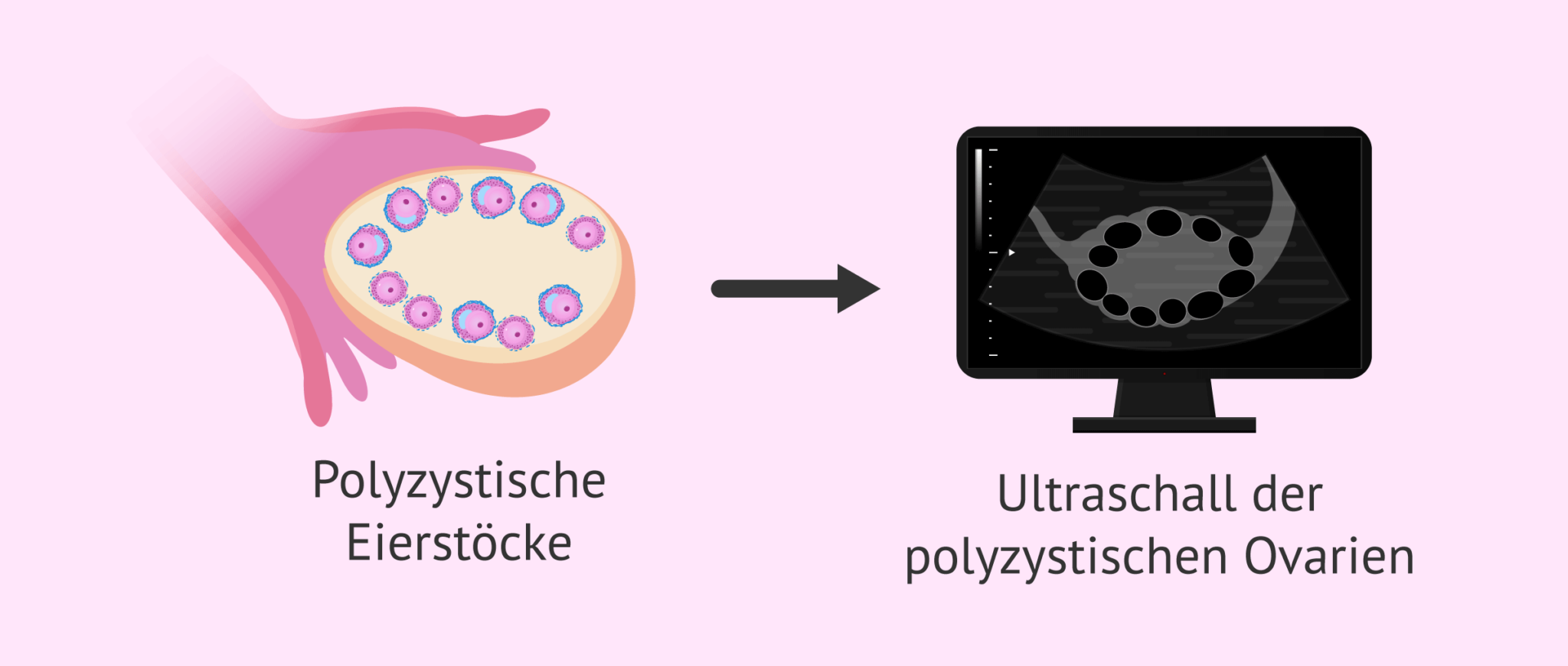 Fruchtbarkeit und polyzystisches Ovarsyndrom (PCOS)