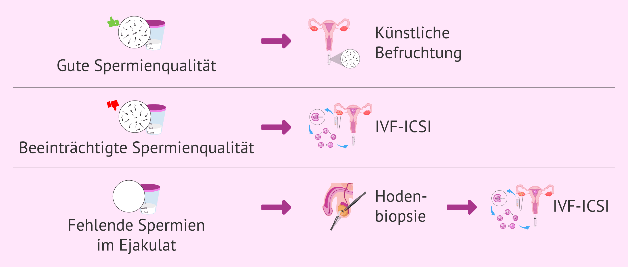 Imagen: Fruchtbarkeitsbehandlungen bei Männern mit Spermienproblemen