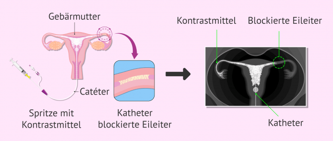 Imagen: Beobachtung der Eileiter mittels Hysterosalpingographie