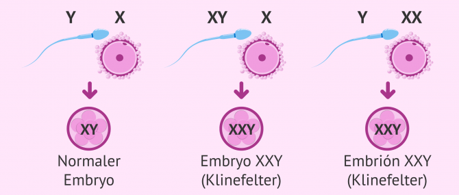 Imagen: Genetische Ursachen des Klinefelter-Syndroms