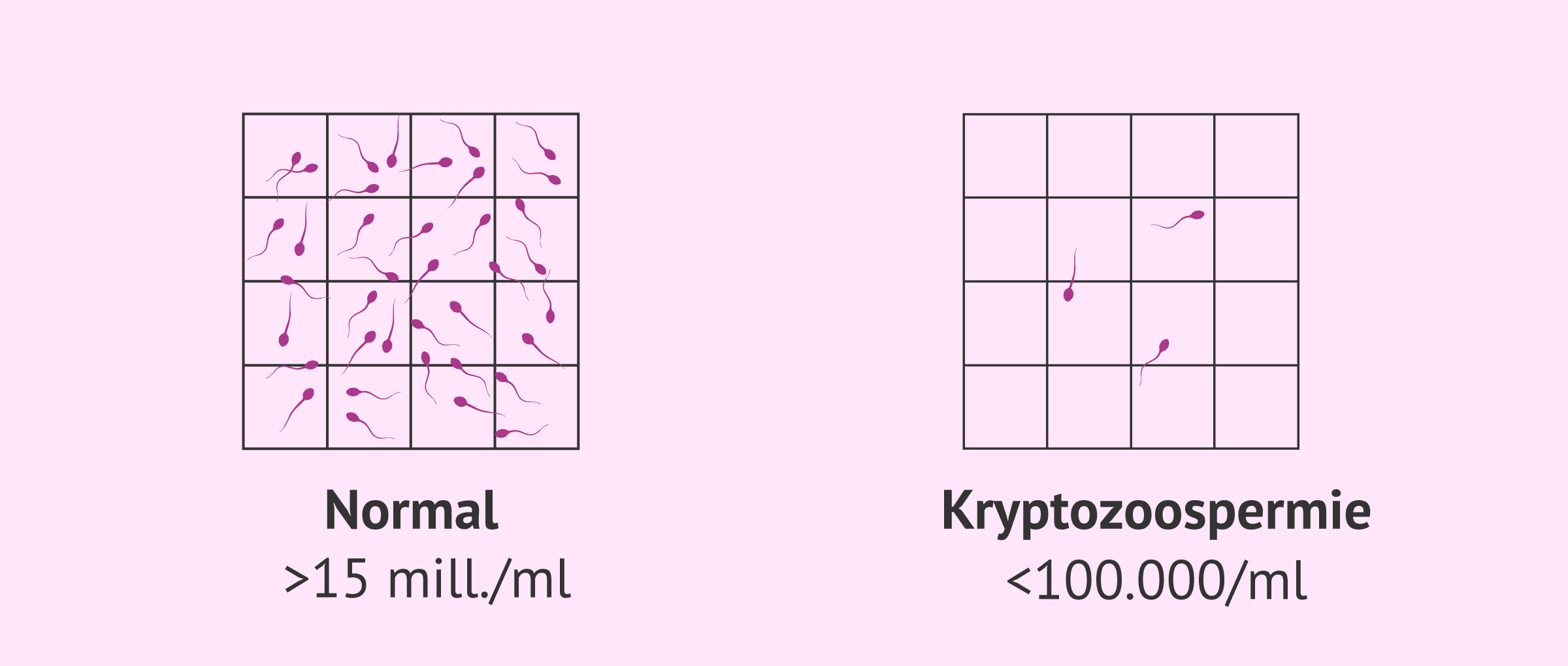 Imagen: Normale Samenprobe und Probe mit Kryptozoospermie
