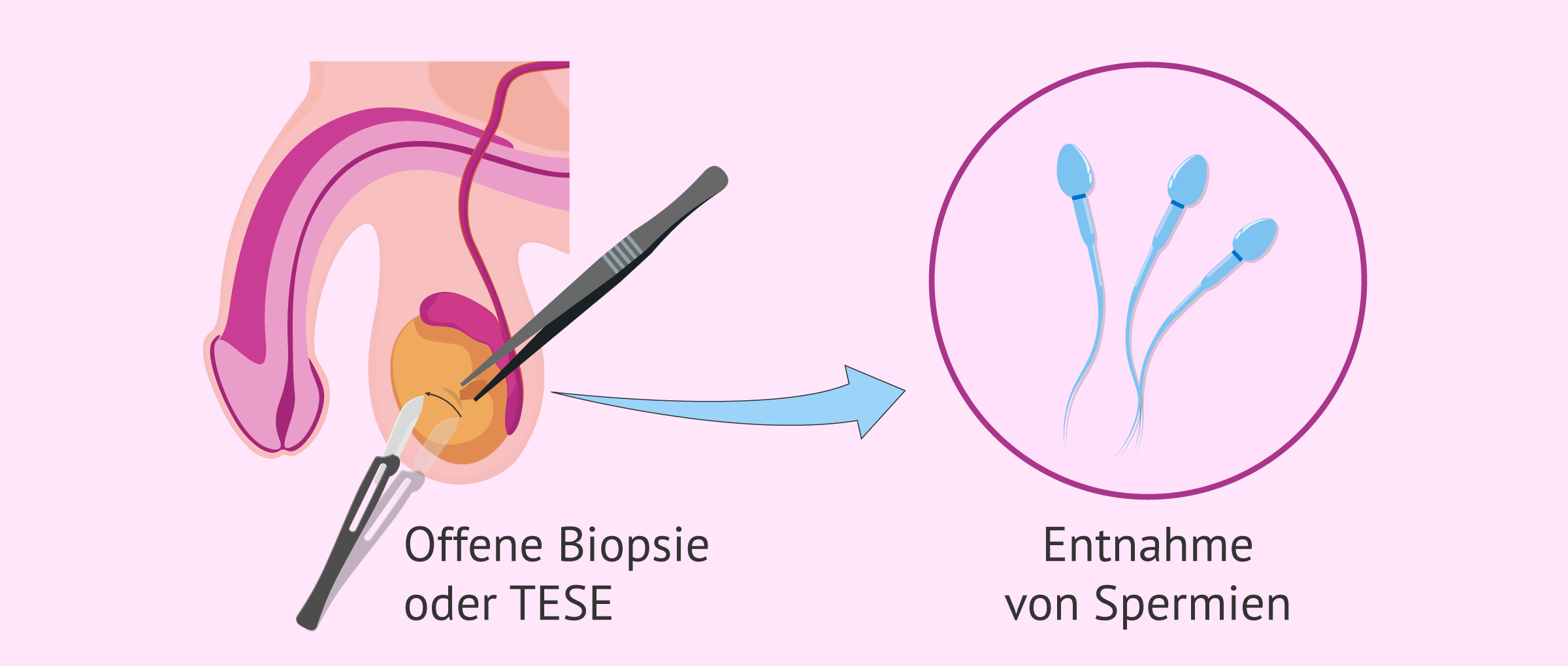 Offene Hodenbiopsie (TESE)