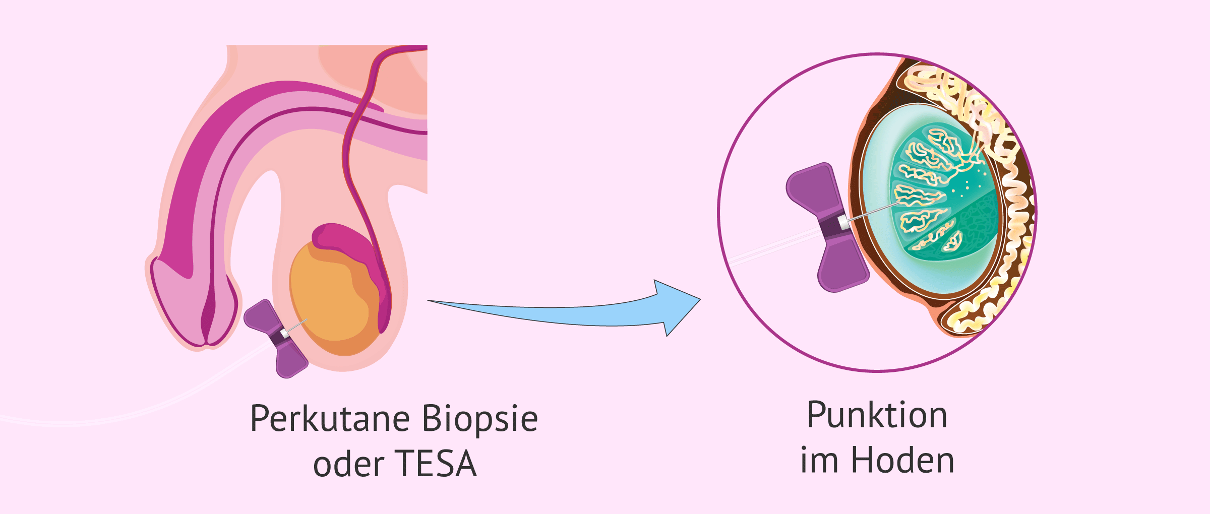 Perkutane Hodenbiopsie (TESA)