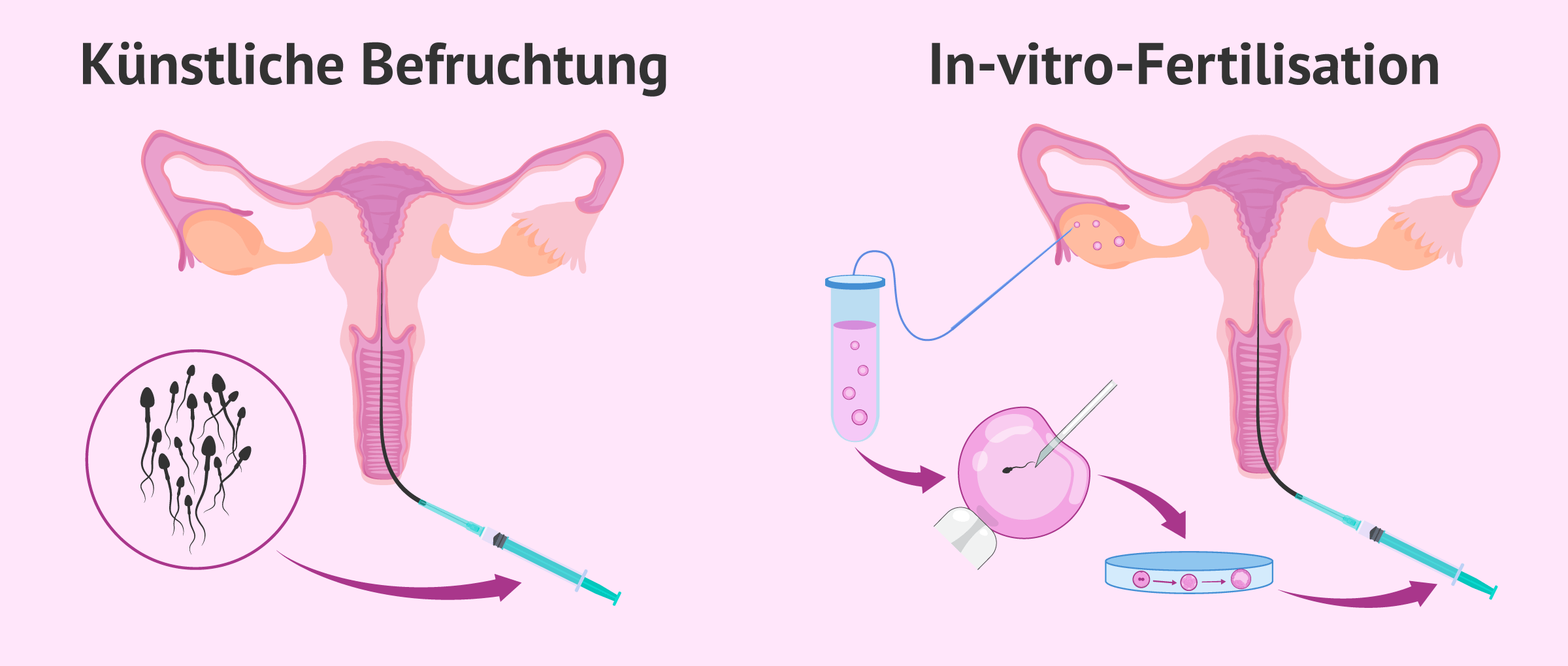 Unterschied im Verlauf zwischen IUI und IVF