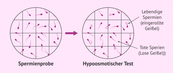Imagen: Hyposmotischer Test für die Diagnose von Nekrospermie