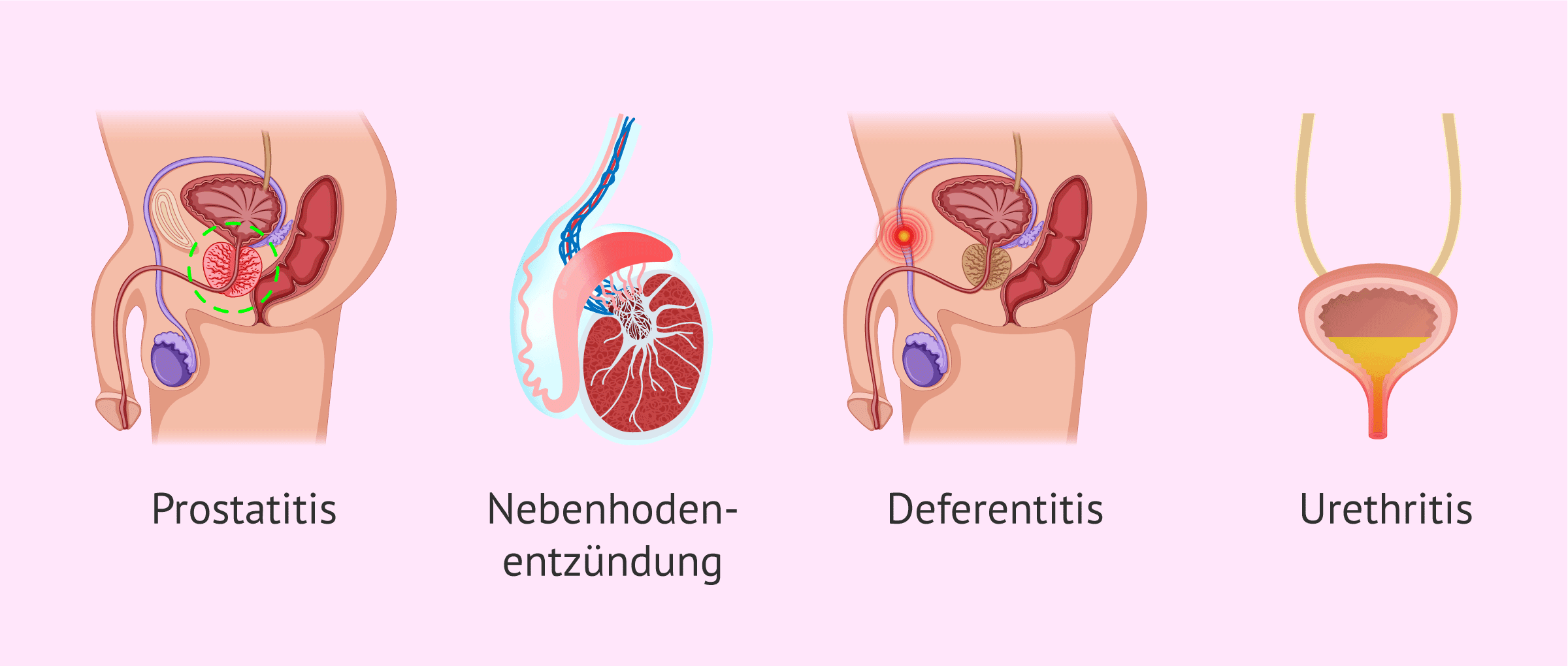 Imagen: Welche Sameninfektionen gibt es?