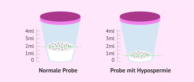 Imagen: Normale Probe und Probe mit Hypospermie