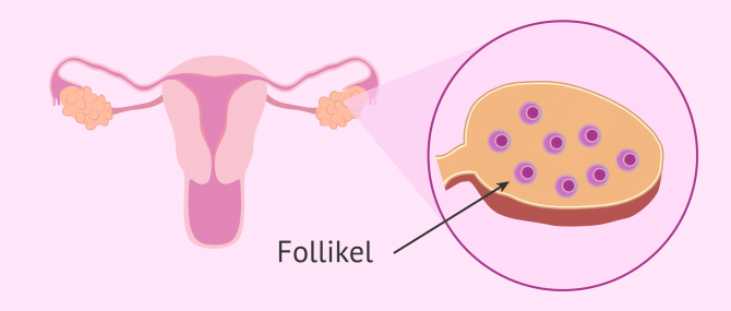 Imagen: Typisches Aussehen von polyzystischen Ovarien