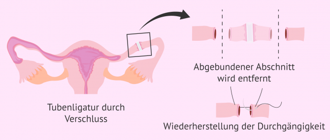 Imagen: Refertilisierung bei Tubenligadur durch Verschluss