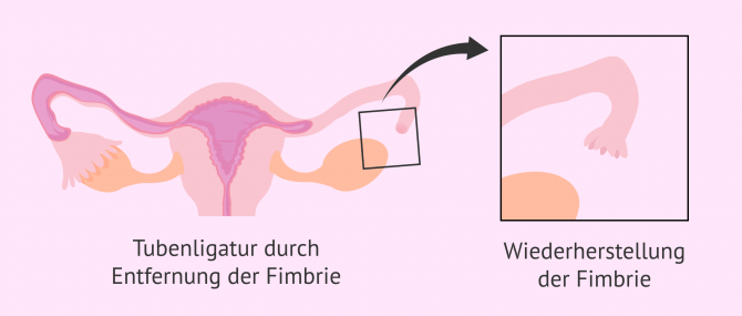 Imagen: Umkehrung der Tubenligatur durch Fimbrien-Rekonstruktion