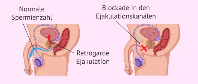 Imagen: Ursachen der Aspermie