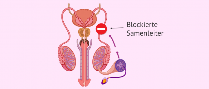 Imagen: Männliche Sterilität durch posttestikulärem Faktor