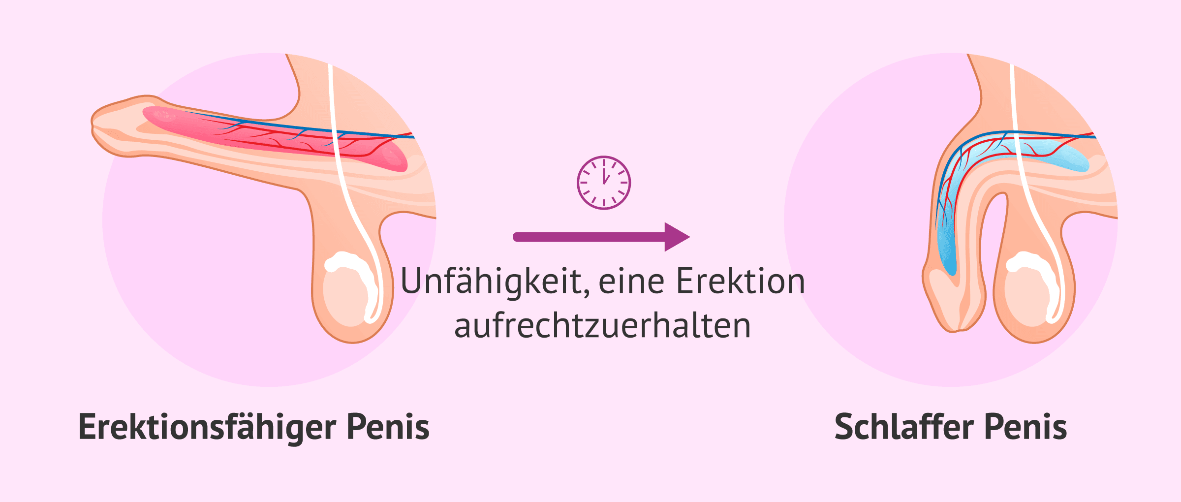Imagen: Was ist sexuelle Impotenz?