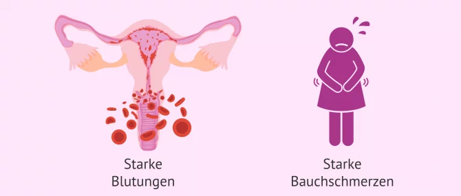 Welche Symptome tauchen nach einem Embryotransfer auf?