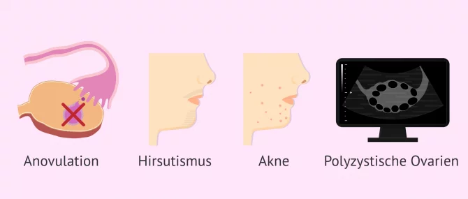 Imagen: Krankheitsbild bei PCO-Syndrom
