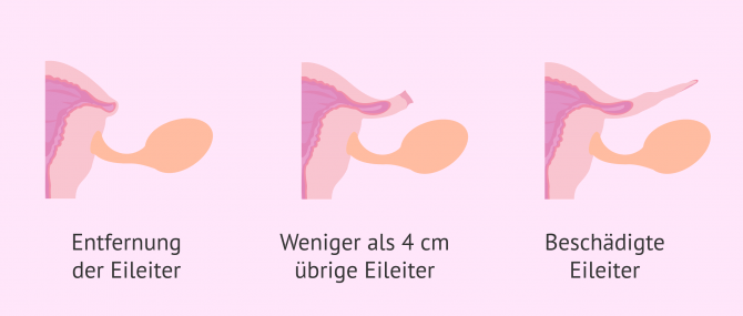 Imagen: Tubenligatur die nicht rückgängig gemacht werden kann