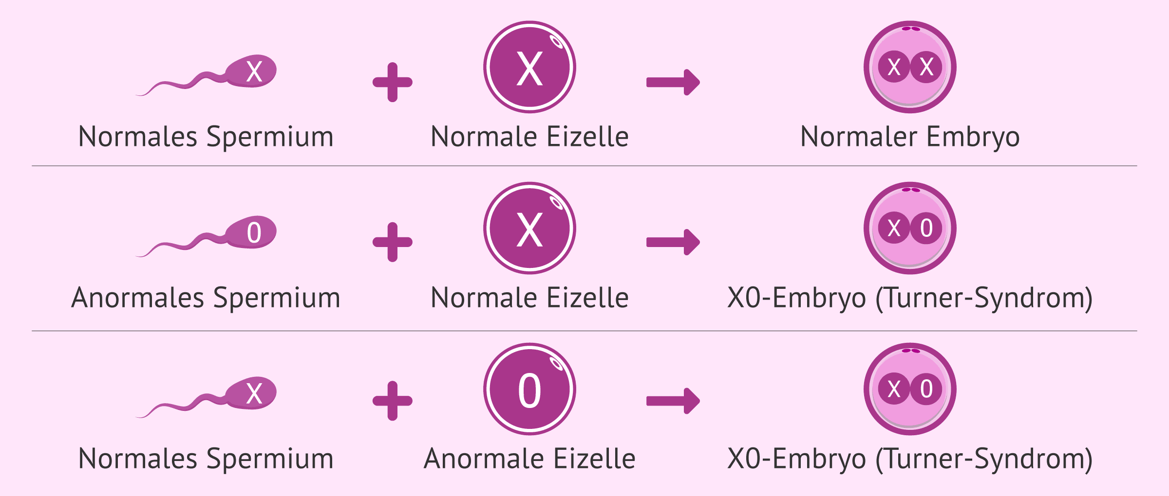 Imagen: Meiotische Theorie zur Ursache des Turner-Syndroms