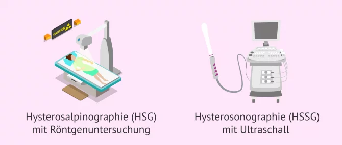 Imagen: Arten von Hysterosalpingographie