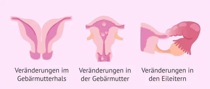 Imagen: Durch HSG diagnostizierte Anomalien