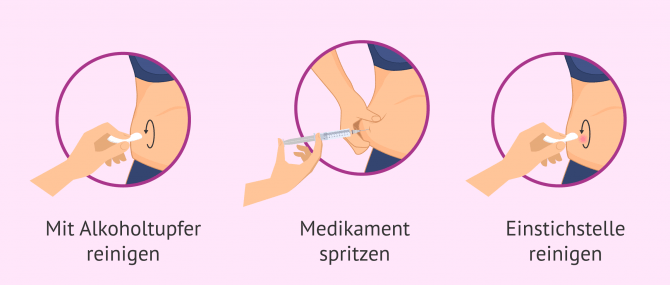 Imagen: Ablauf bei der Injektion von Luveris 75 IE