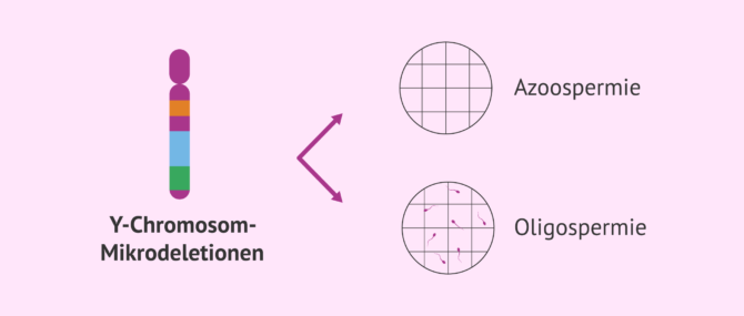 Imagen: Y-Chromosomen-Mikrodeletionen als Ursache für männliche Unfruchtbarkeit