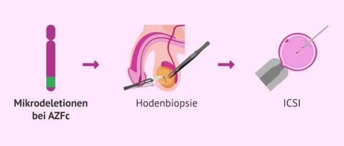 Imagen: Assistierte Reproduktionstechniken mit Mikrodeletionen auf dem Y-Chromosom