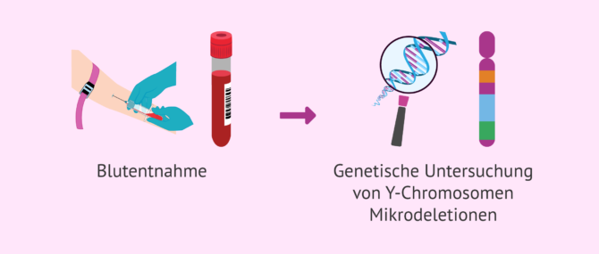 Imagen: Wie werden Y-Chromosom-Mikrodeletionen diagnostiziert?