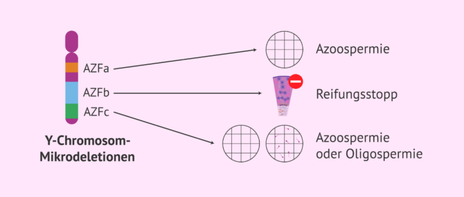 Imagen: Mikrodeletionen des Y-Chromosoms: Typen