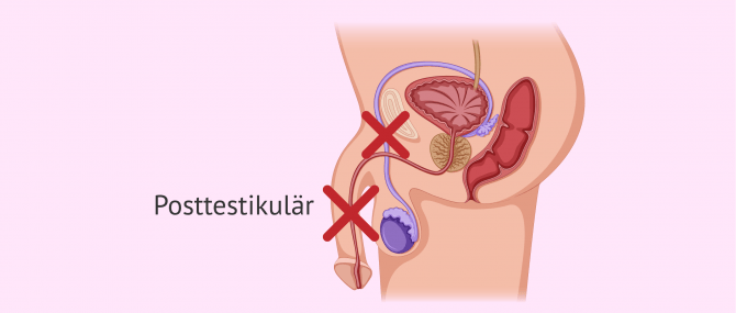 Imagen: Postestikuläre Ursache der Azoospermie