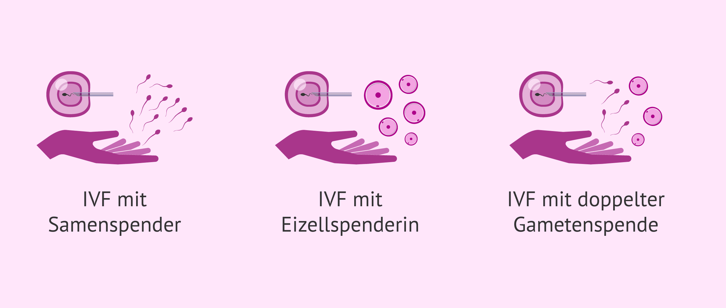 Imagen: Alternativen der IVF mit Gametenwechsel