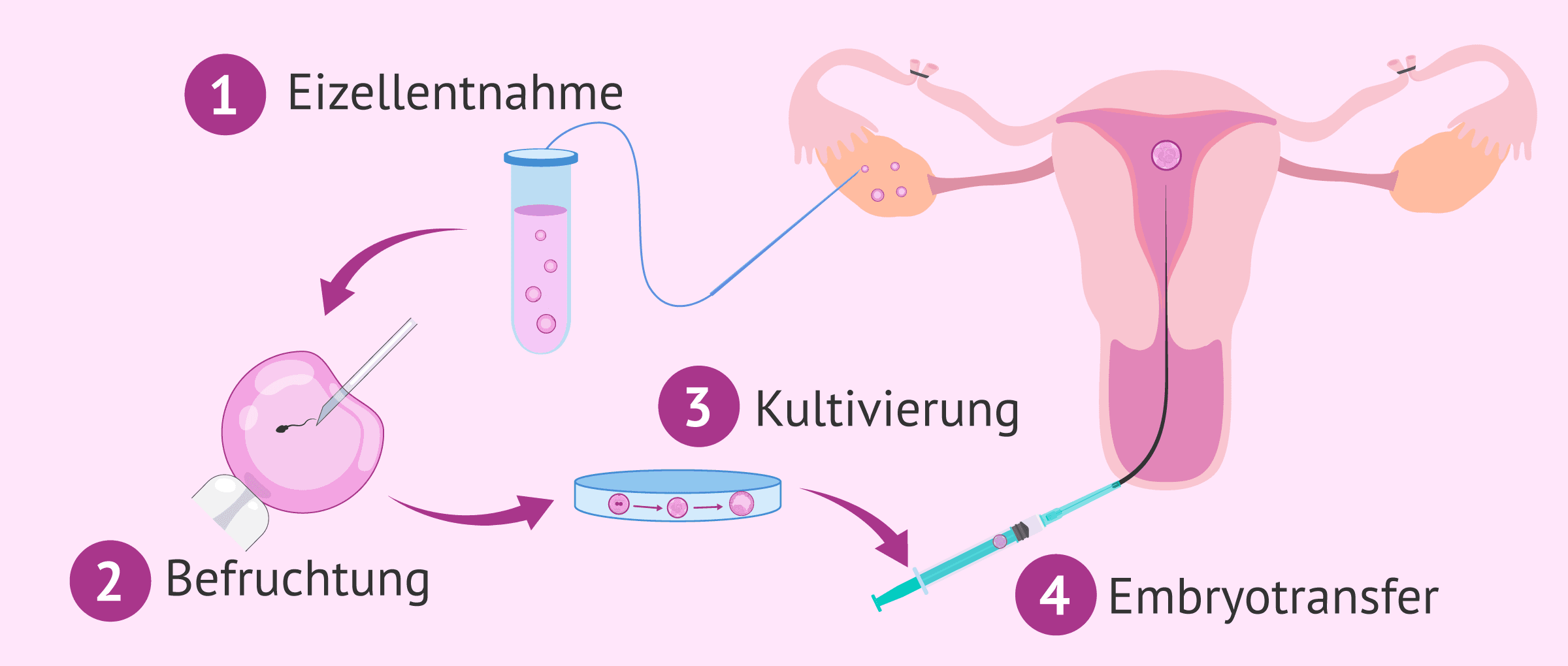 Imagen: IVF bei Eileiterunterbindung