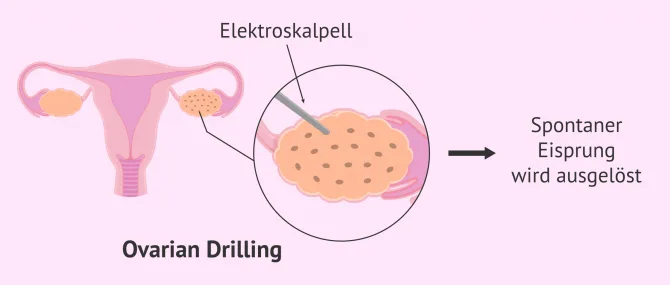Imagen: Ovarian Drilling bei PCO