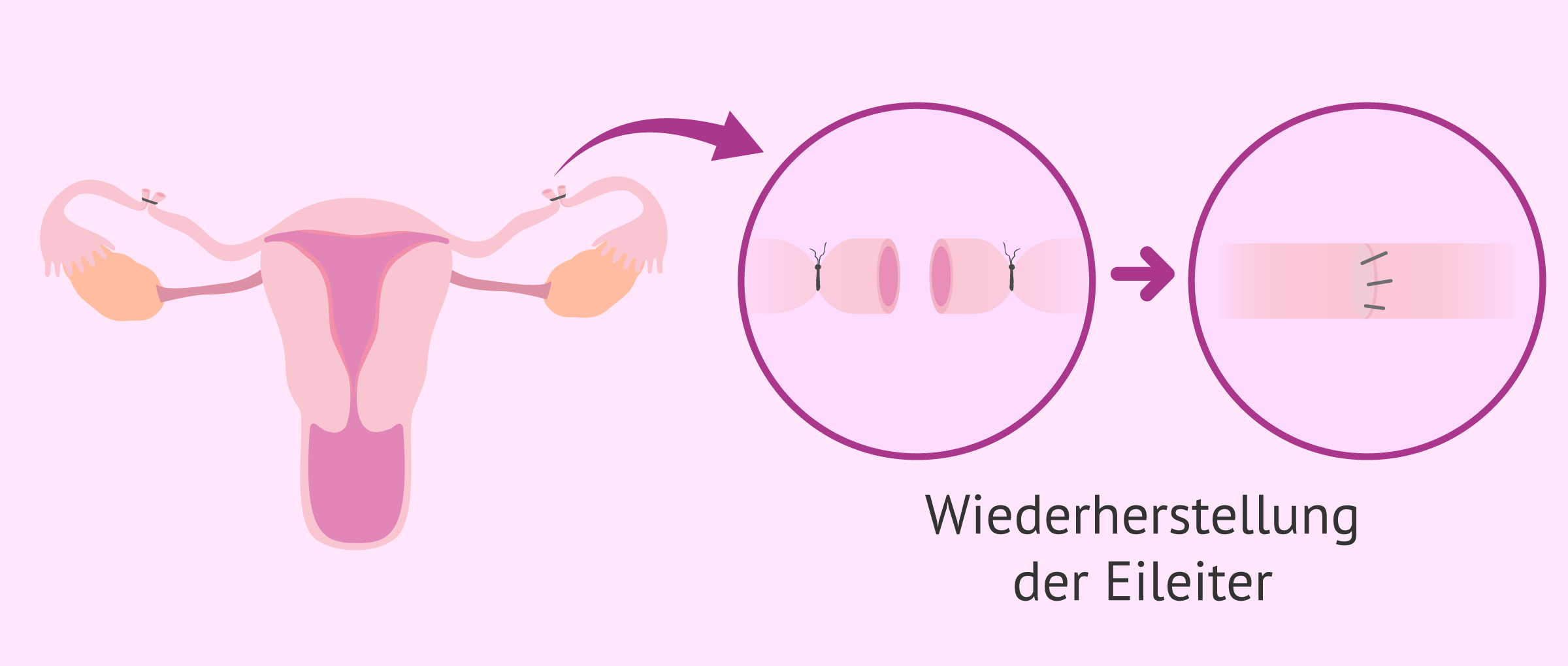Imagen: Rückgängigmachung der Eileiterunterbindung (Refertilisierung)