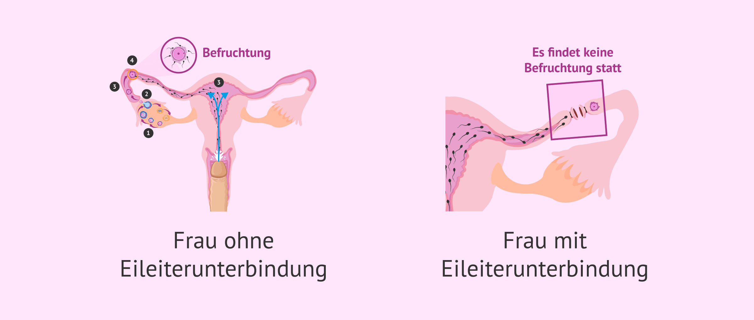 Wahrscheinlichkeit einer Schwangerschaft nach einer Eileiterunterbindung